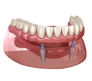 Ball-retained implant denture for lower arch