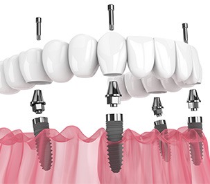 Fixed implant denture for lower arch