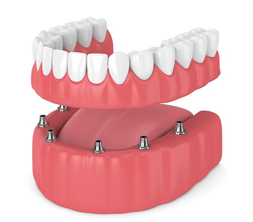 Illustration of implant denture pictured against white background